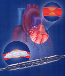 Angioplasty with stent