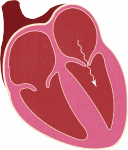 mitral stenosis