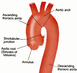Dilated ascending aorta causes || uncoiling of aorta || ~chelation