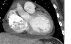 Pericardium thickened